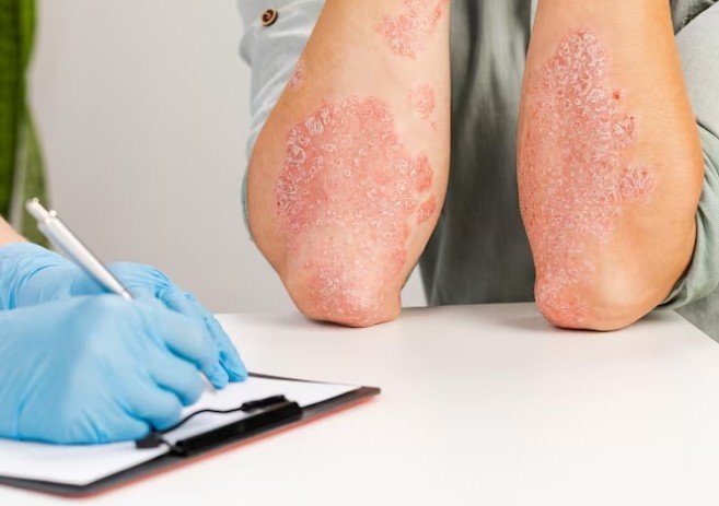 Best Psoriasis Neurotherapy in Ghaziabad