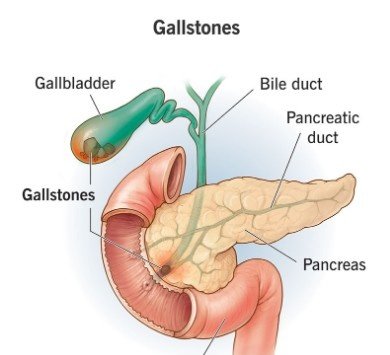 Best Doctor for Gallstones in North Delhi