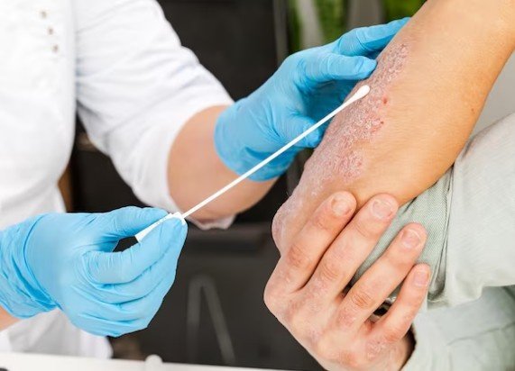 Best Psoriasis Treatment in Vivek Vihar