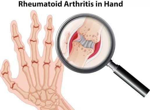 Best Arthritis Treatment in Noida